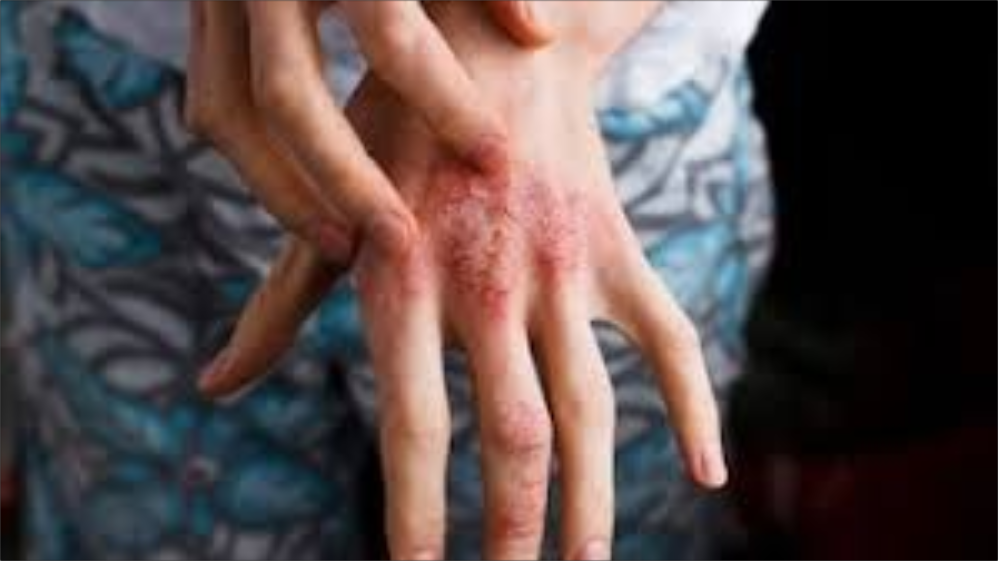  El desconocimiento sobre la psoriasis favorece que se perpetúen estigmas que afectan a las personas que la padecen